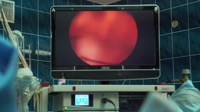 Operation prostatectomy on the monitor screen during the manipulation. Treatment of prostate adenoma.