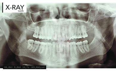 Xray teeth mouth dental tomography. Vector X-ray radiology oral panorama. Medical skeleton x ray background. 