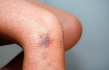 The bruise on human skin, background blurred, People with knee pain that are bruised.