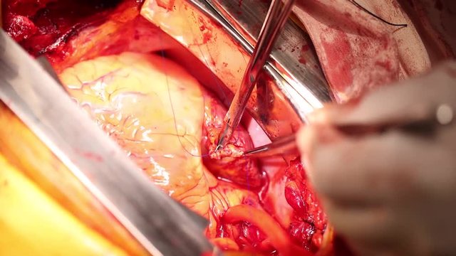 Open Heart Surgery, human beating heart.