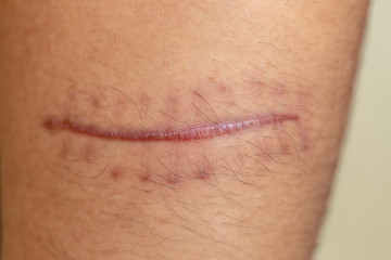 A scar is an area of fibrous tissue that replaces normal skin after an injury on skin. 