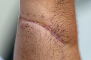 A scar is an area of fibrous tissue that replaces normal skin after an injury on skin. 