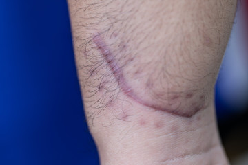 A scar is an area of fibrous tissue that replaces normal skin after an injury on skin. 
