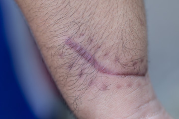 A scar is an area of fibrous tissue that replaces normal skin after an injury on skin. 
