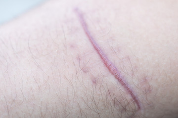 A scar is an area of fibrous tissue that replaces normal skin after an injury on skin. 