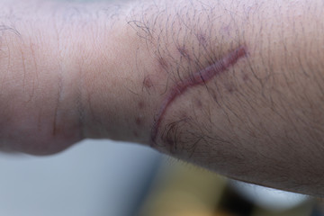 Fototapeta premium A scar is an area of fibrous tissue that replaces normal skin after an injury on skin. 