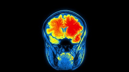 Computed medical tomography MRI upscaled scan of healthy young female head. Front view. Optically retimed for smooth motion. Red, yellow, blue on black background.