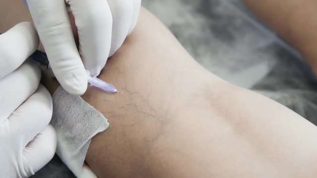 Close-up hands of phlebologist in gloves does procedure of sclerotherapy on leg of patient