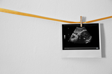 Ultrasound photo hanging on ribbon against white background, space for text