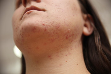 Allergy concept,young girl with problematic pimple on the face.-image. - 259631240