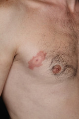 Lyme disease, or Lyme borreliosis, is a bacterial infection spread to humans by infected ticks. The rash is often described as looking like a bull's-eye on a dart board. Erythema migrans (ER).