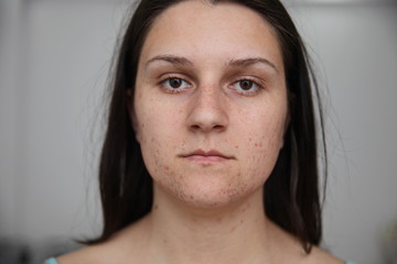 Allergy concept,young girl with problematic pimple on the face.-image.