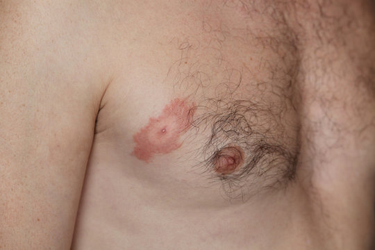 Lyme disease, or Lyme borreliosis, is a bacterial infection spread to humans by infected ticks. The rash is often described as looking like a bull's-eye on a dart board. Erythema migrans (ER).