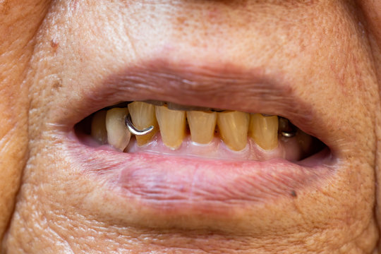 Silver metal Artificial teeth in the mouth of senior woman, Stomatology & False Dentures set concept, Close up & Macro shot, Selective focus