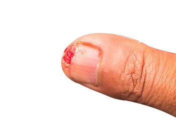 Deep wound on the fingers.