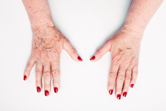 1 044 Best Age Spots On Hands Images Stock Photos Vectors Adobe Stock 1 044 Best Age Spots On Hands Images Stock Photos Vectors Adobe Stock