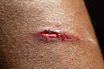 Closeup view an open flesh wound on a person