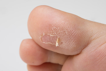 Closeup view of a callus on the underside of a big toe