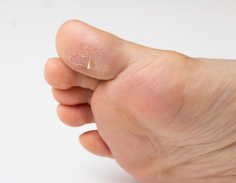 Dry skin on hotsell bottom of big toe