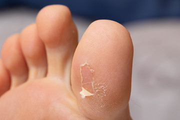 Close-up view of a callus on the underside of a person’s big toe