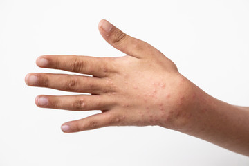 Closeup view of a spotted rash on the hand and arm of a child