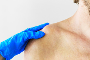 Dislocation or fracture of the clavicle and acromial process with displacement. The doctor examines...