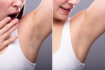 Fototapeta na wymiar Before And After Concept Of Underarm Hair Removal