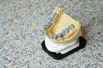 Dental impressions of teeth for manufacture of prostheses and correcting bite. Lower jaw © Vagengeim