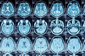 MRI scan of the brain