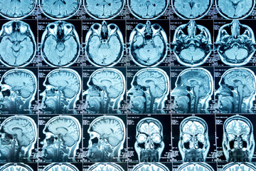 MRI scan of the brain