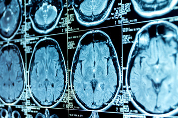 MRI scan of the brain