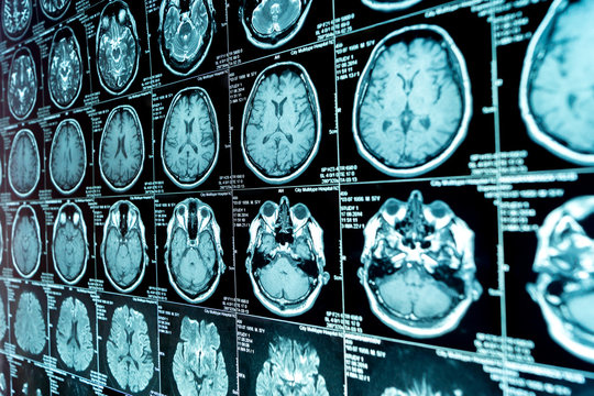 MRI scan of the brain