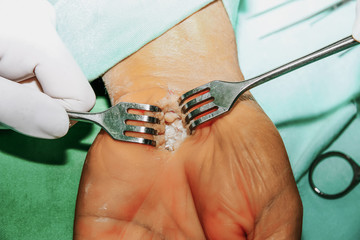Human hand surgery