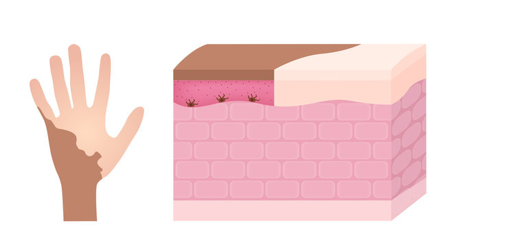 vitiligo on skin layer anatomy vector / melanin