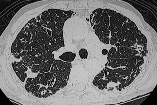 Lung Multiple Sites Of Infection, CAT Scan