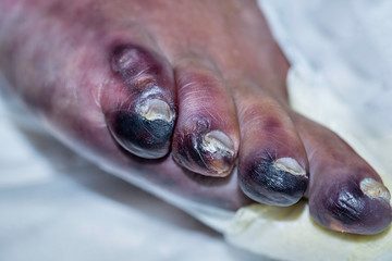 Closeup of foot with gangrene - obrazy, fototapety, plakaty