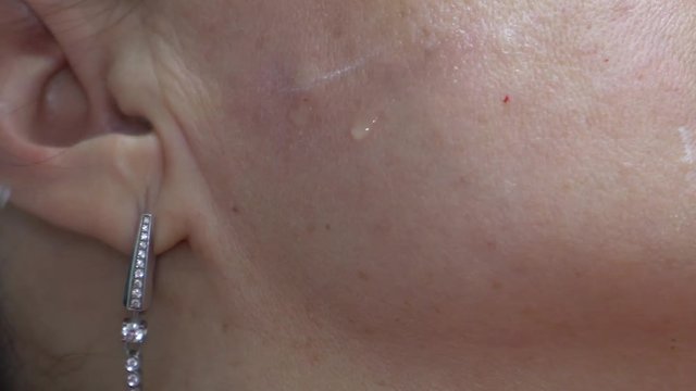 Cosmetologist performs several injections in the area of the girl's cheekbone to the patient. Botox injection.