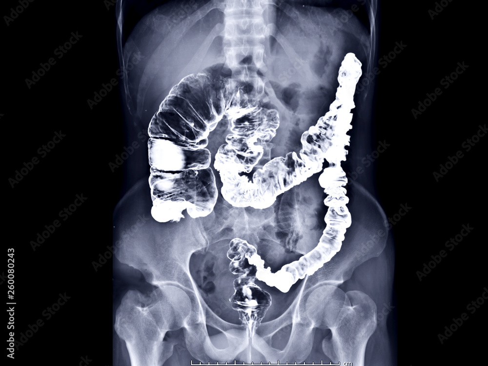 Poster barium enema image or x-ray image of large intestine ap view showing anatomical of large intestine o