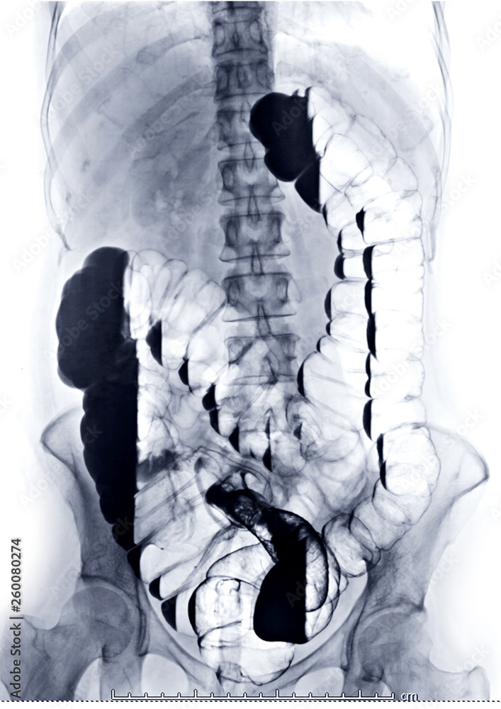 Poster barium enema image or x-ray image of large intestine or colon showing anatomical of large intestine 