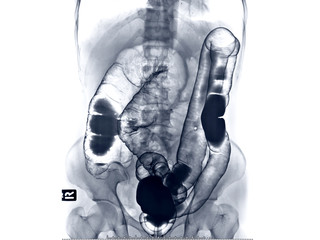 barium enema image or x-ray image of large intestine AP view showing anatomical of large intestine...