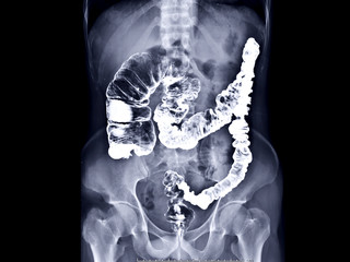 barium enema image or x-ray image of large intestine AP view showing anatomical of large intestine...