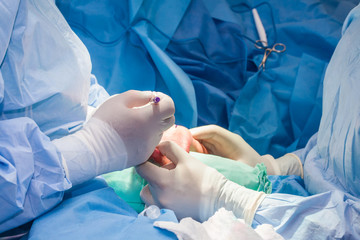 Doctors performing a hand surgery