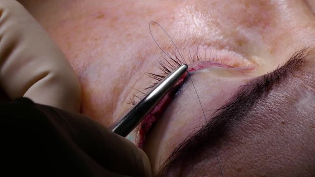 The doctor scissors separates the skin under the patient's eye during plastic surgery.