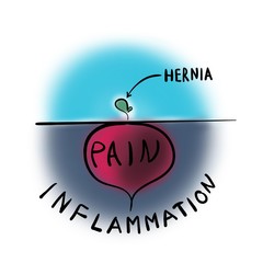 Intervertebral hernia and pain