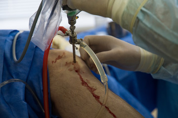 Knee keyhole surgery hospital arthroscopy operation medical procedure in hospital. Surgeons at work.