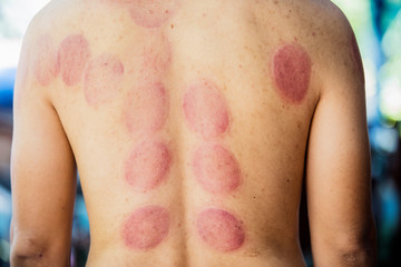 The back of the man with blood marks by cupping treatment,Cupping therapy marks on the back,Chinese treatment
