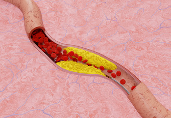 Atherosclerosis in Artery. Medical Concept. 3D illustration