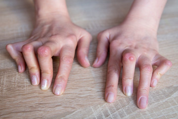 Young woman's hands deformed from Rheumatoid Arthritis.
