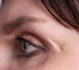 deep scar and scar on the face of the girl near the eye, close-up, skin problem, cosmetology