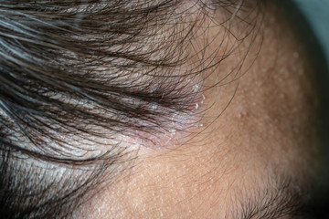 Skin diseases, on the scalp ,Woman with dandruff in her dark hair